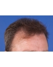 Before Hair Transplant&nbsp;Front